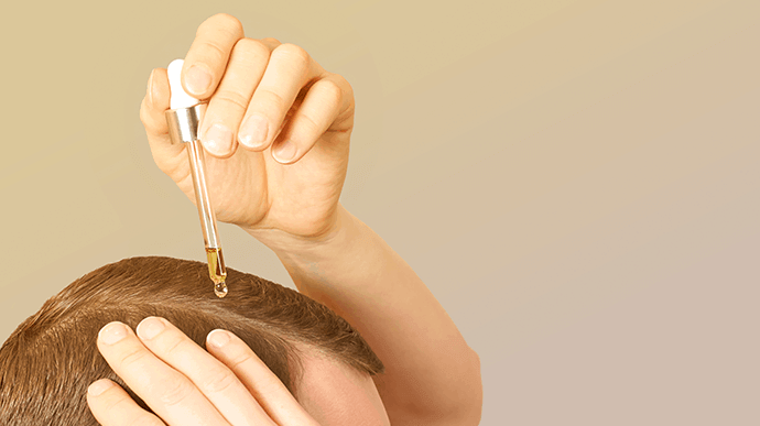 Calvície: Entenda o que pode causar e como prevenir